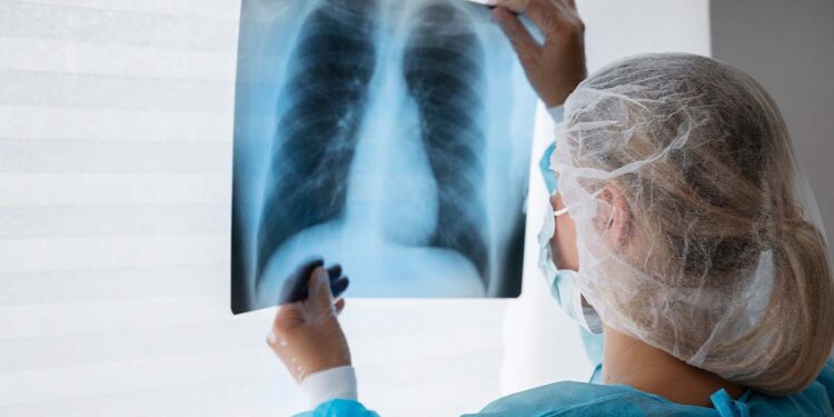 Fumo e rastreamento: os aliados na guerra contra o câncer de pulmão, alerta oncologista da Hapvida!