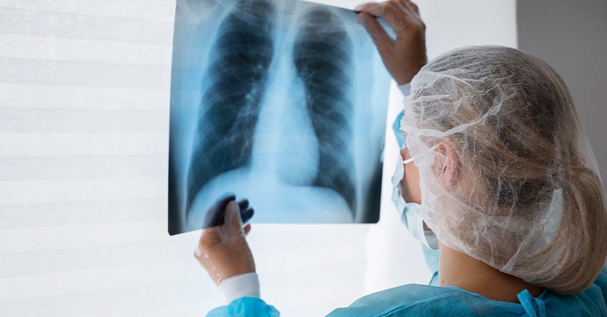 Fumo sob vigilância: oncologista revela táticas explosivas para derrotar o câncer de pulmão!